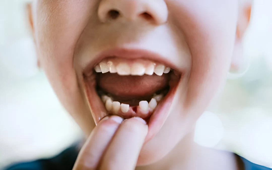 What to Do If Your Child Knocks Out a Tooth: A Step-by-Step Guide