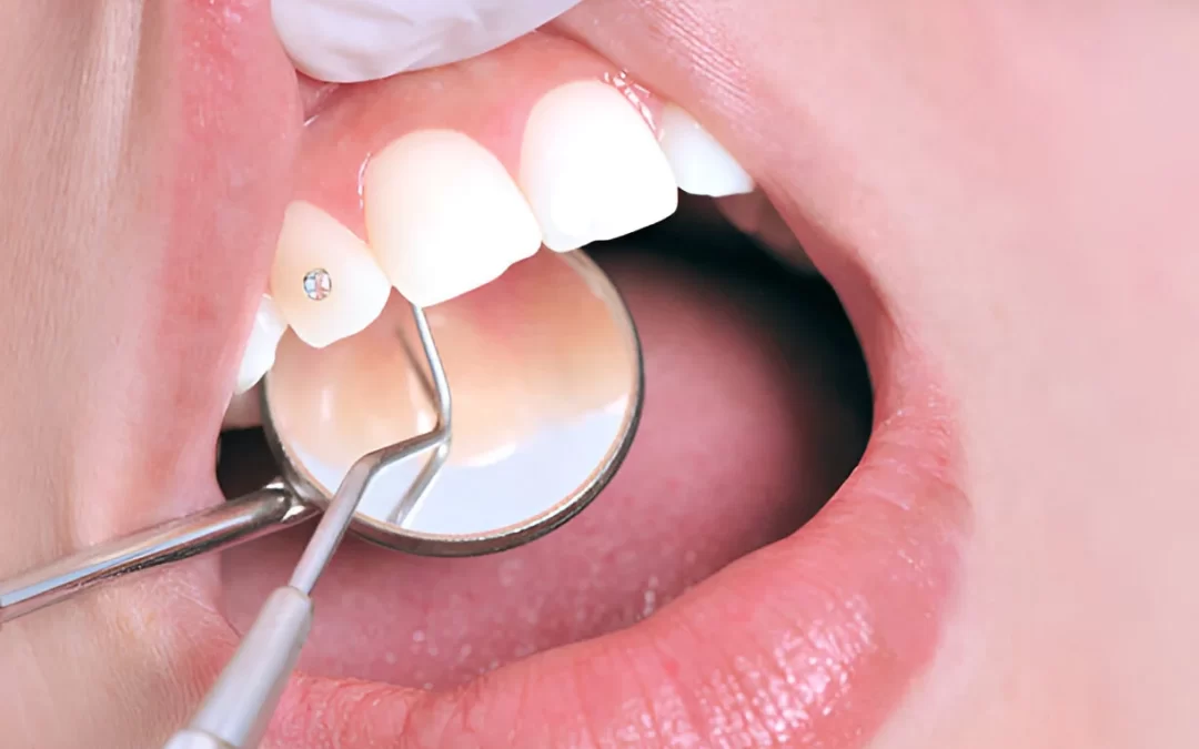 Dazzling Smiles: The Elegance of Dental Jewelry for a Radiant Look