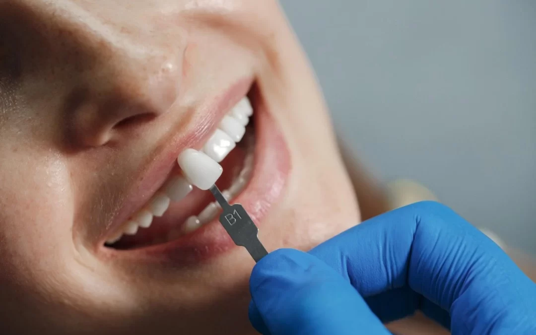 All-on-4 Dental Implants: The Ultimate Solution for Full Mouth Restoration